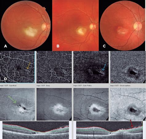 SciELO - Brasil - Toxoplasmosis outbreak in São Paulo, Brazil ...