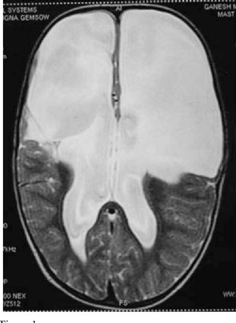 Figure From Perioperative Outcome Of Pacemaker Patients Undergoing