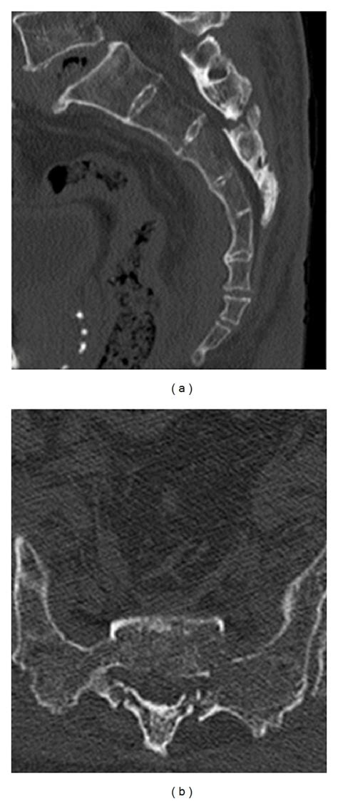 Preoperative Reconstructed Computed Tomogram CT A Sagittal