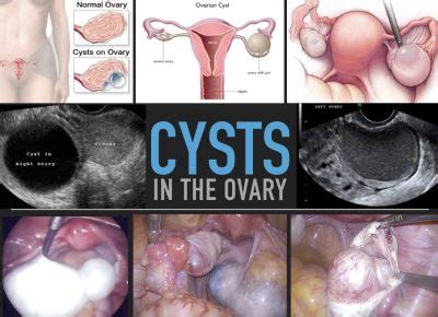 Ovarian Cysts Anthony Siow