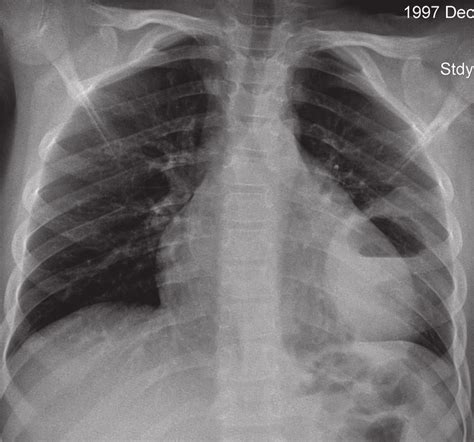 A Plain Chest Radiograph Showing A Thick Walled Cavity With Air Fluid