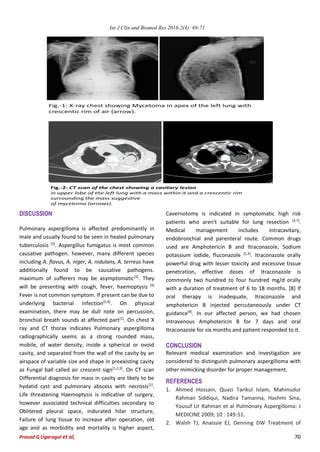 Pulmonary aspergilloma | PDF