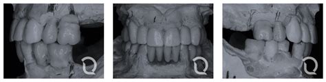 Caso de enfermedad periodontal avanzada con rehabilitación fija