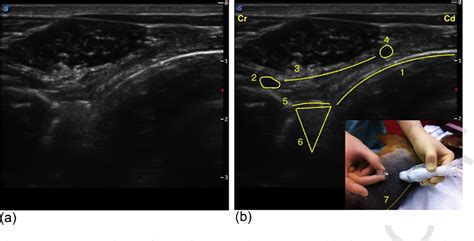 Figure From Ultrasound Guided Thoracic Paravertebral Block Cadaveric