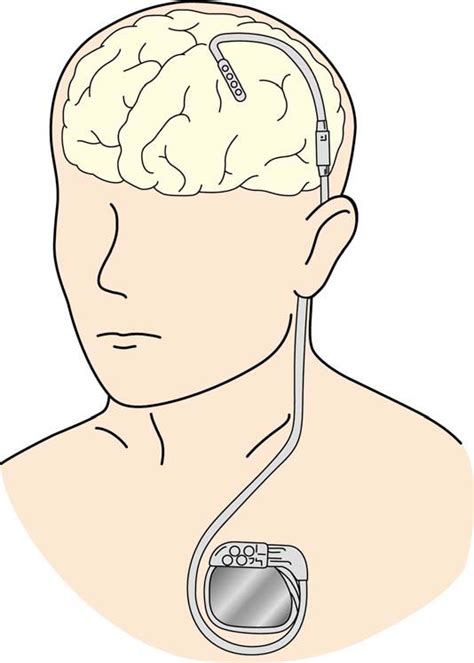 Scheme of electrical motor cortex stimulation. | Download Scientific ...