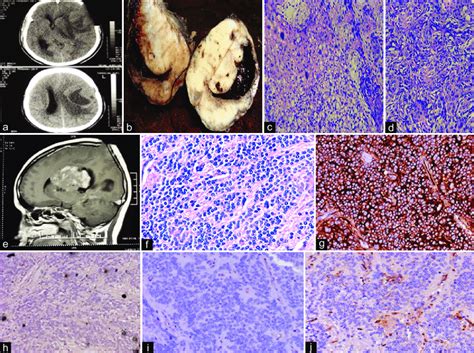 (a-i) Clear cell tumors of CNS. (a) Meningioma MRI picture, (b ...