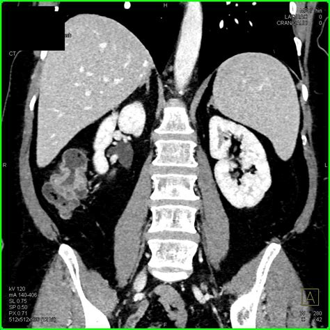 Incidental Cecal Carcinoma with Apple Core Like Lesion - Colon Case ...