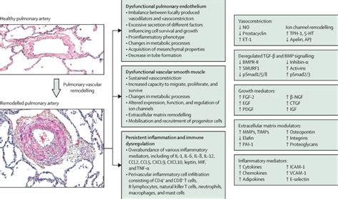 Treatment Of Pulmonary Arterial Hypertension Recent Progress And A