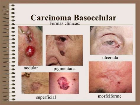 Carcinoma Basocelular