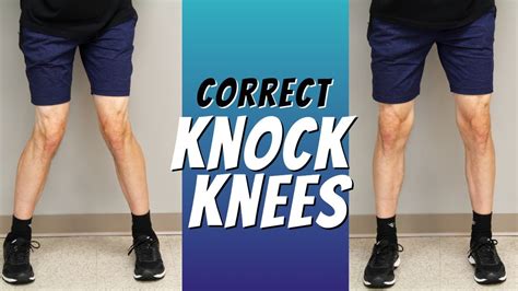 Top 5 Ways To Correct Knock Knees With Exercise Etc Youtube