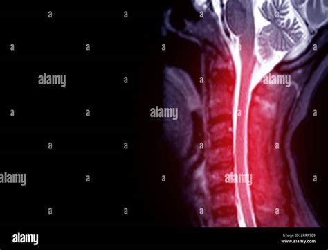 Mri Of C Spine Or Magnetic Resonance Image Of Cervical Spine Sagittal