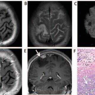 PDF Neuroimaging Findings Of Cerebral Syphilitic Gumma