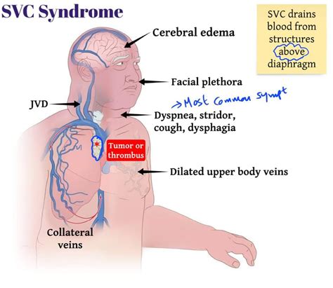 Superior Vena Cava Syndrome Collateral Circulation