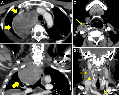 Skip And Mediastinal Metastasis In Papillary Thyroid Cancer Radiology