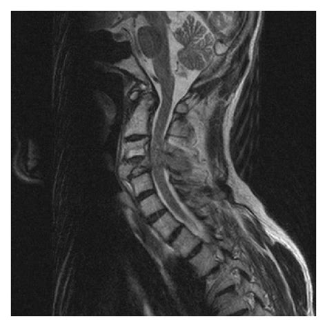 MRI of the cervical spine demonstrating erosive metastatic tumor of the ...