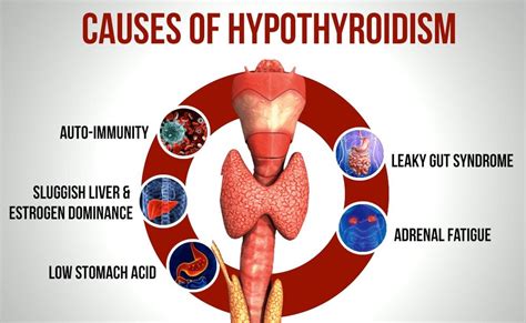 Understanding Hypothyroidism — The Holistic Health Approach