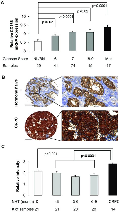 Gene Expression Profiling And Tissue Microarray Tma Demonstrates That