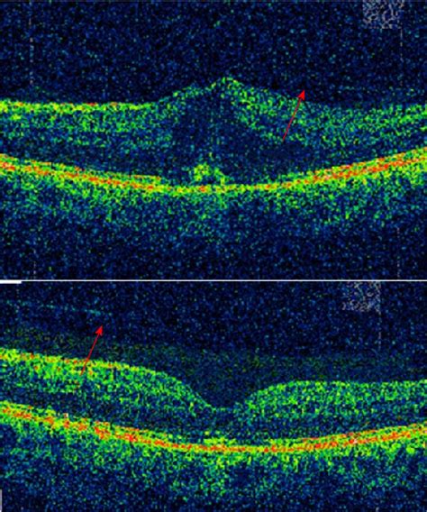 Figure 2 From Enzymatic Vitrectomy For Diabetic Retinopathy And