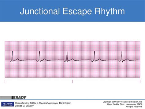 Ppt Introducing The Junctional Rhythms Powerpoint Presentation Free Download Id 3366298