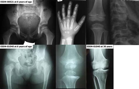 Radiographic Findings In PSACH And MED Patients With Mutations