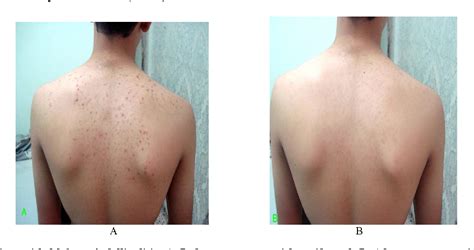 Pityrosporum Folliculitis Chest