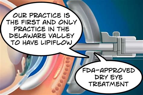 Dry Eye Philadelphia How Lipiflow Works - Treatment for Severe Dry Eye ...