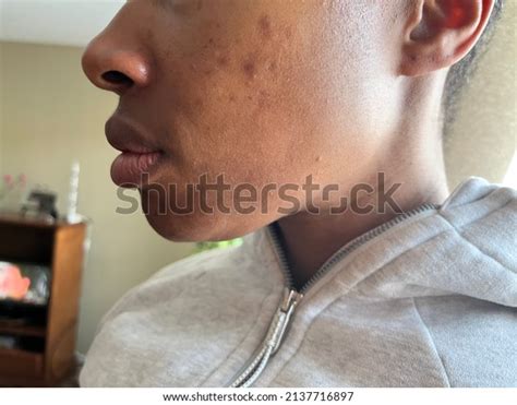 Pih Acne Photos Images Pictures Shutterstock