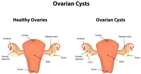 Size Of Ovarian Cyst Chart Ovarian Cyst Stock Vector. Illust