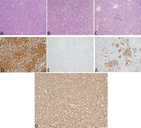 Frontiers Solitary Fibrous Tumor With Igf Ii Induced Non Islet Cell Tumor Hypoglycemia A Case