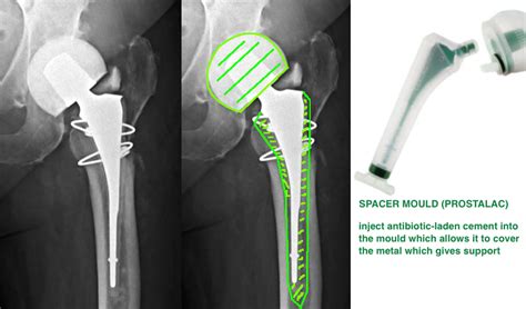 Infection Hip Knee Book