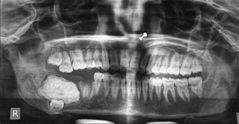 Incisive Foramen Radiograph