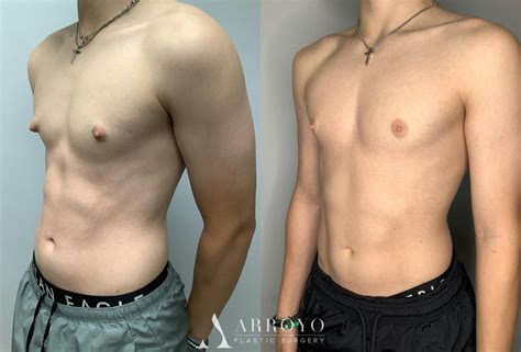 Gynecomastia Before And After Photos Arroyo Plastic Surgery