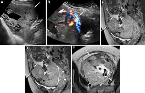 Placenta Accreta Spectrum Disorders Update And Pictorial Review Of The Sar Esur Joint Consensus