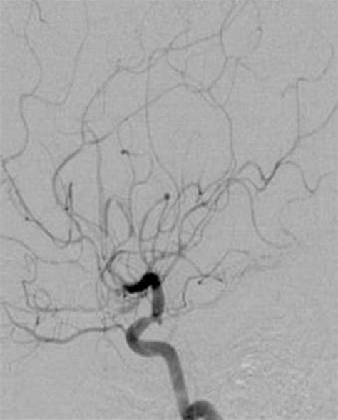 Imaging Spectrum Of Cns Vasculitis Radiographics