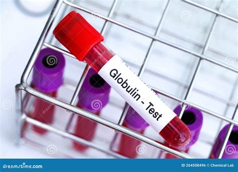 Globulin Test To Look For Abnormalities From Blood Stock Photo Image