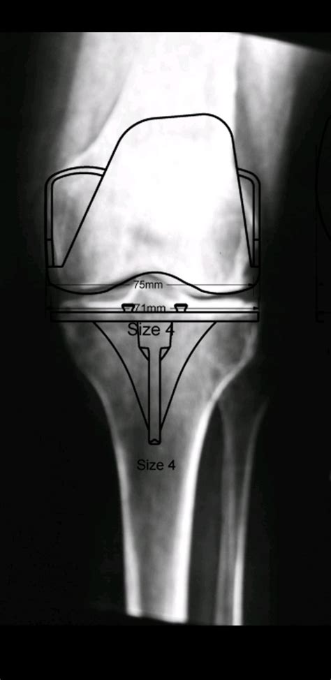 Pr Tesis Total De La Rodilla Dr Ngel Vega Curiel