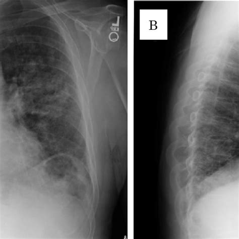 Chest X Rays A Postero Anterior View B Lateral View Reveal Diffuse