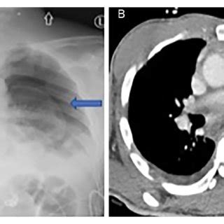 A Supine Portable Anteroposterior Radiograph Of The Chest Shows