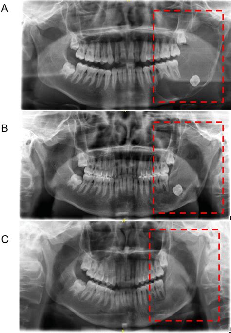 Comparison Of Pre Operative And Post Operative Results Of Fdsc In Download Scientific Diagram