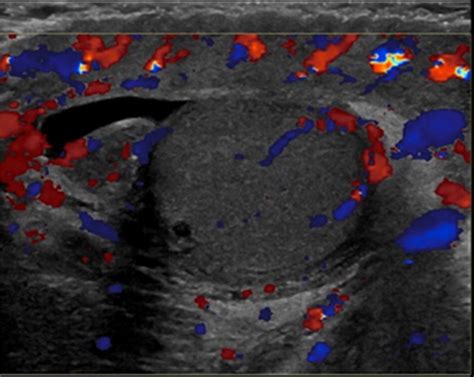 Spared Testis In Fournier Gangrene Color Doppler Us Image Shows Download Scientific Diagram