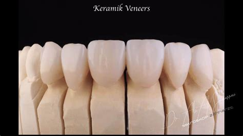 Veneers Und Lumineers Keramikverblendungen Wien