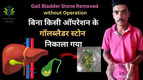 Gall Bladder Stone Removed Without Operation Natural And Easy Way To