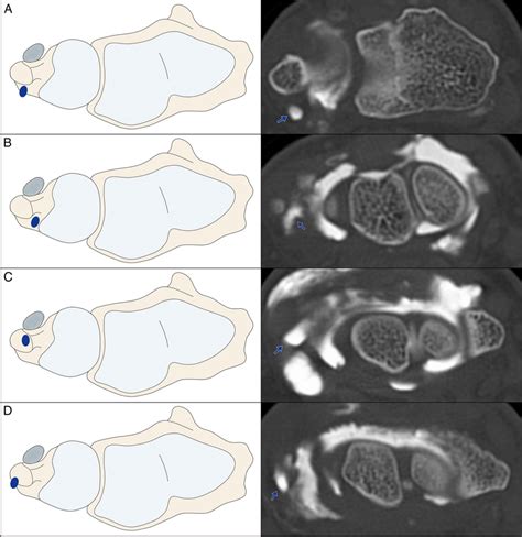 Schematic Display Of Different Prestyloid Recess Positions In The Axial