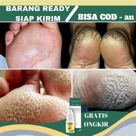 Jual Obat Telapak Kaki Rayapan Obat Telapak Kaki Bolong Bolong Dan