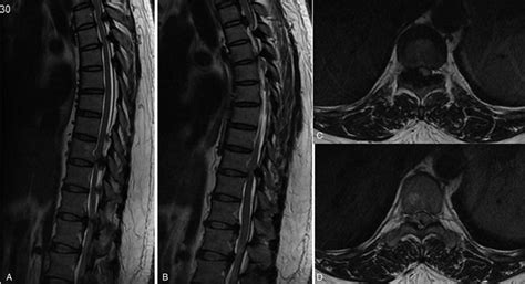 Preoperative Magnetic Resonance Imaging T9 And 10 Ossification Of The