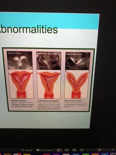 OB Test 2 Complications Of Pregnancy Flashcards Quizlet