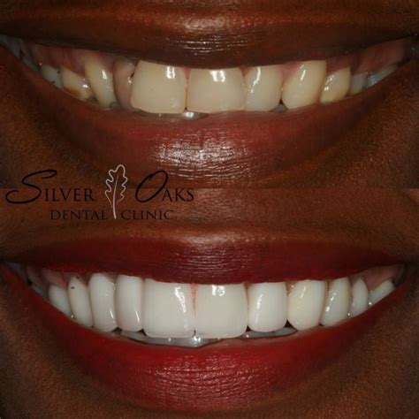 The Cost Of Dental Veneers Silver Oaks Dental Clinic