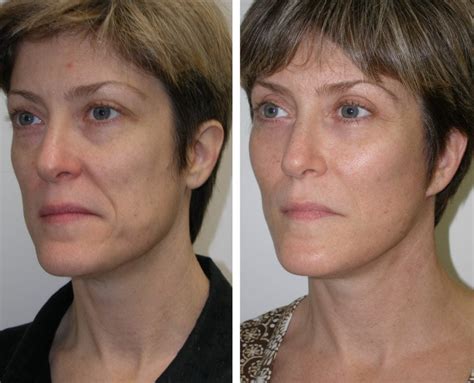 Cheek Implants Richmond VA | Facial Fillers | Midface Implants