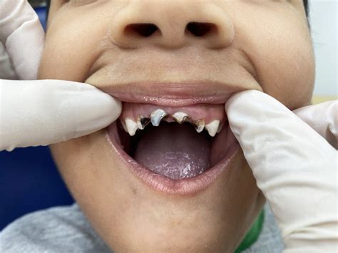 Por Qu Es Importante Prevenir Las Caries En Ni Os Un Caso Real