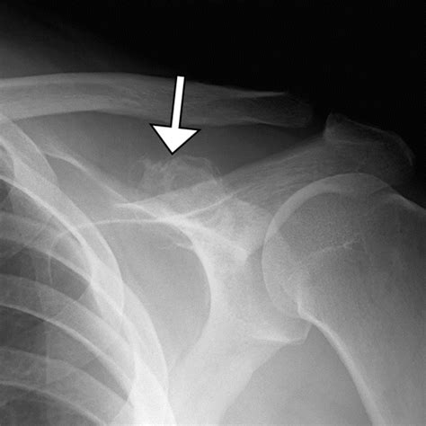 Coracoid Process The Lighthouse Of The Shoulder Radiographics